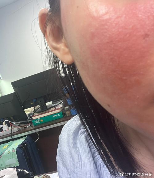 冬天脸干红怎么办?