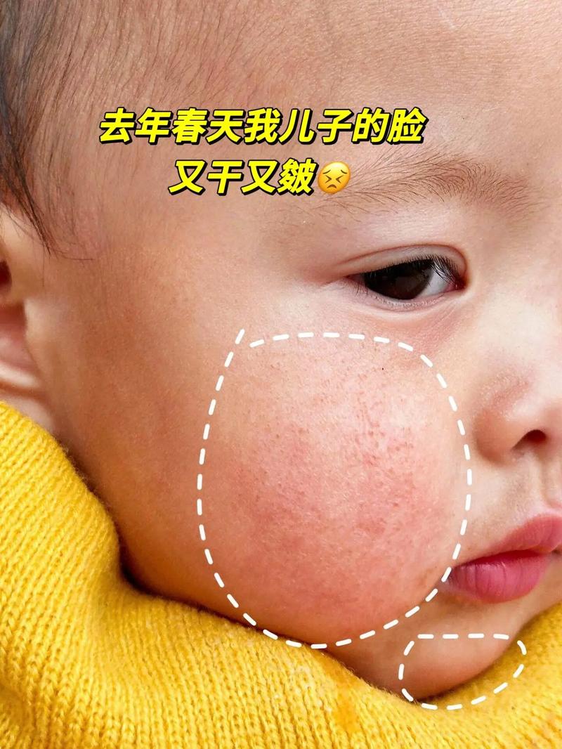 冬天脸干红怎么办?