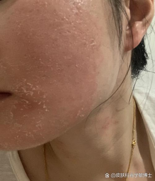 冬天脸干红怎么办?