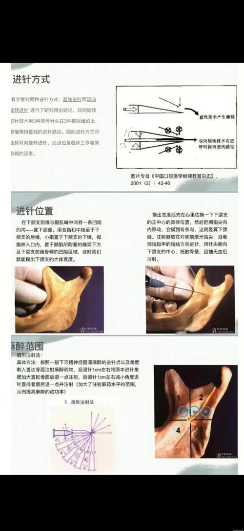 口腔打麻药进针点图有哪些关键位置?