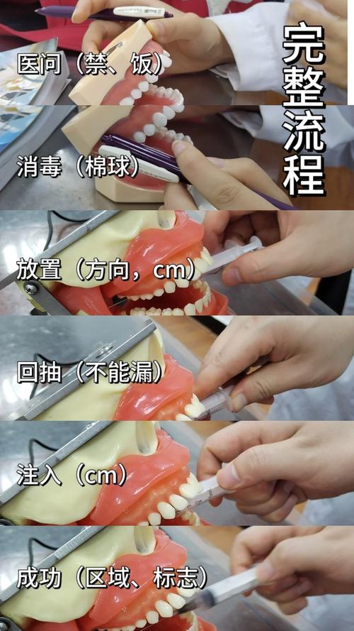 口腔打麻药进针点图有哪些关键位置?