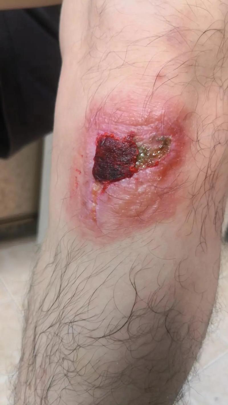 皮肤莫名破损是何病?