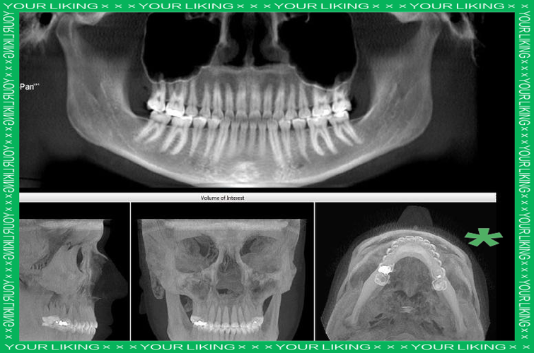 拍口腔全景片辐射大吗