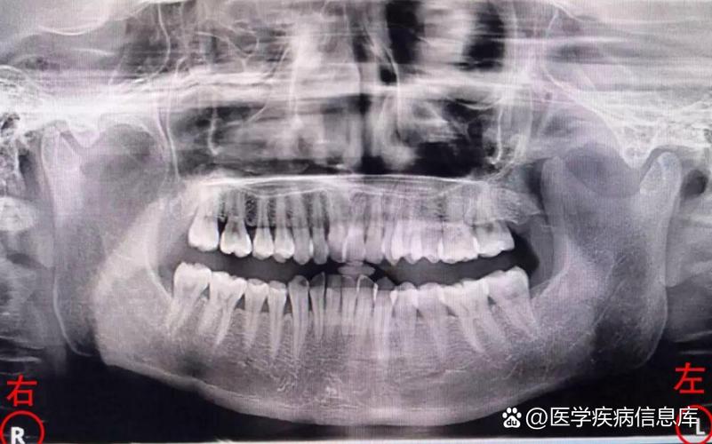 拍口腔全景片辐射大吗