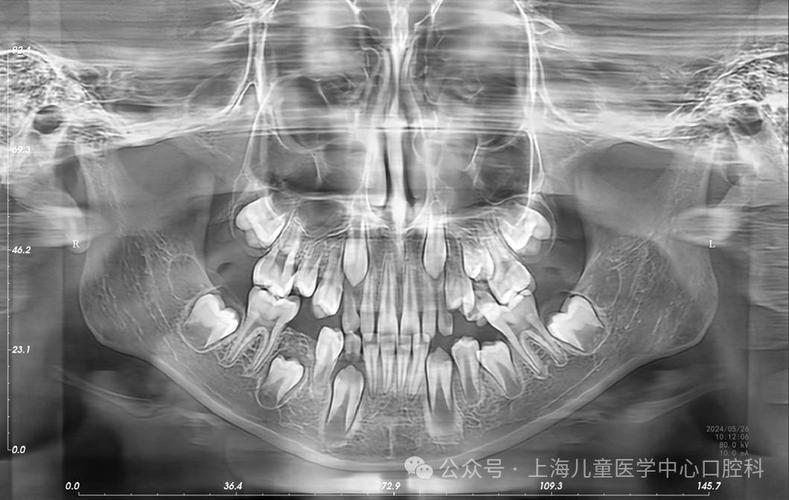 拍口腔全景片辐射大吗