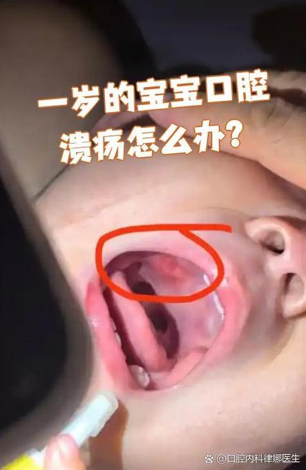 婴儿口腔溃疡多久能好