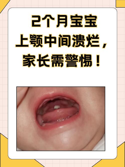 婴儿口腔溃疡多久能好