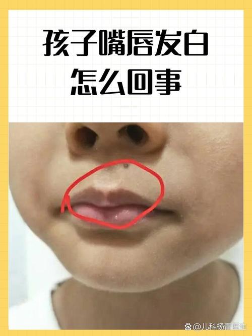 宝宝嘴巴周围皮肤发白