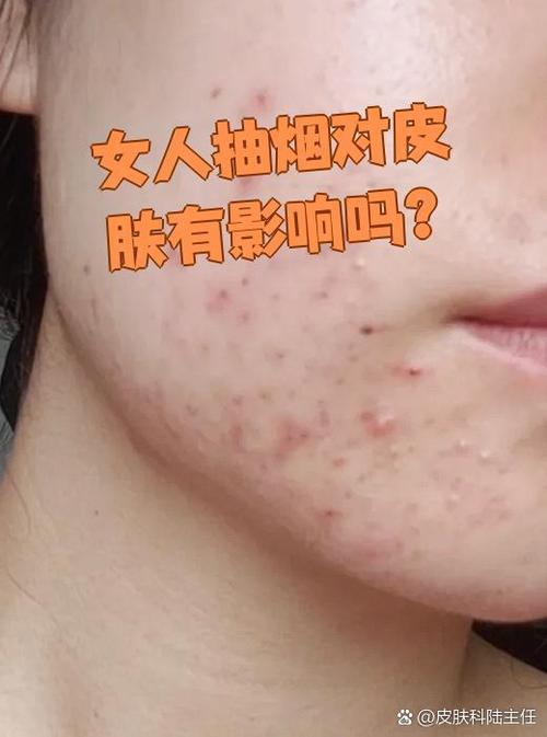 女性戒烟后皮肤多久能明显改善?