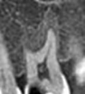 牙齿磨口腔内壁怎么缓解?