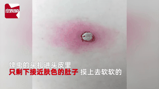 梦见虫子钻进皮肤吸血是何征兆?