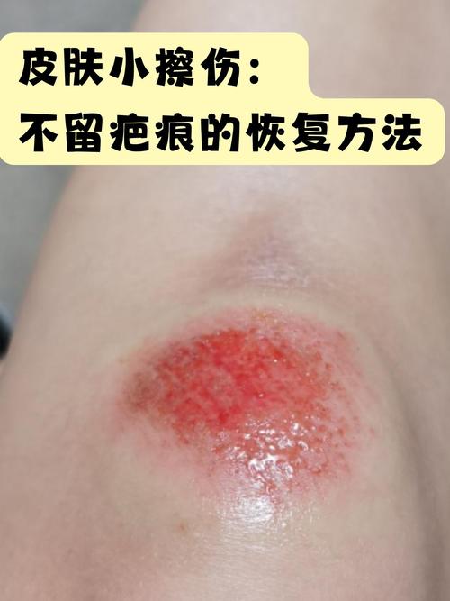 受伤皮肤如何快速恢复?