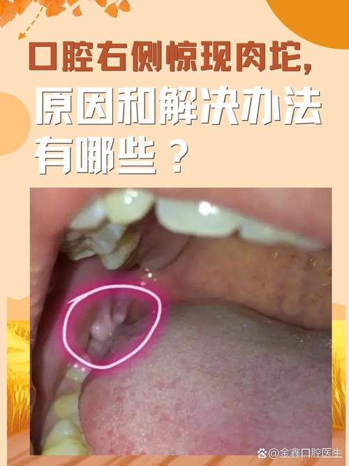 口腔淋巴结石为何引发口臭?