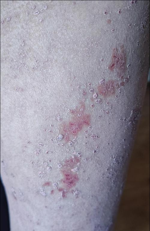 带状疱疹后皮肤痒,如何有效缓解?