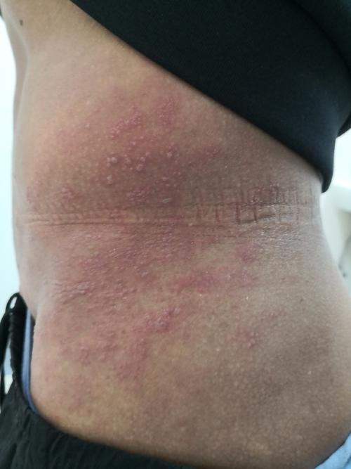 带状疱疹后皮肤痒,如何有效缓解?