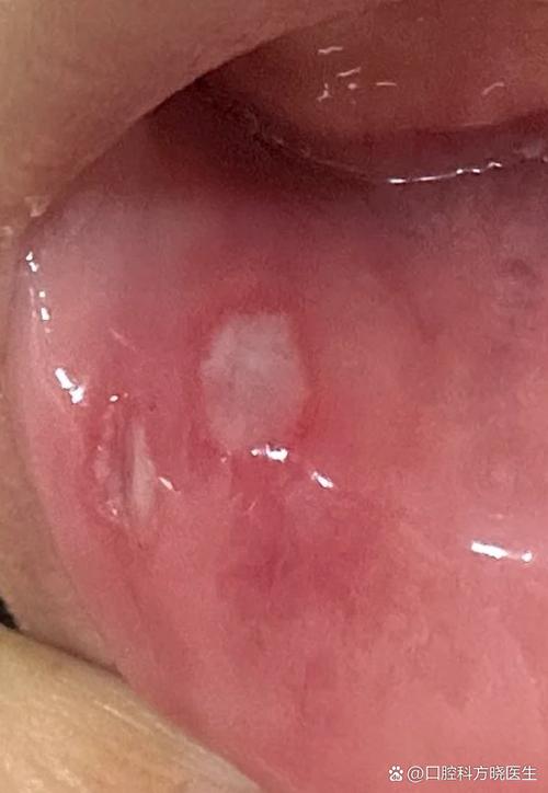 口腔粘膜病有哪些典型症状?