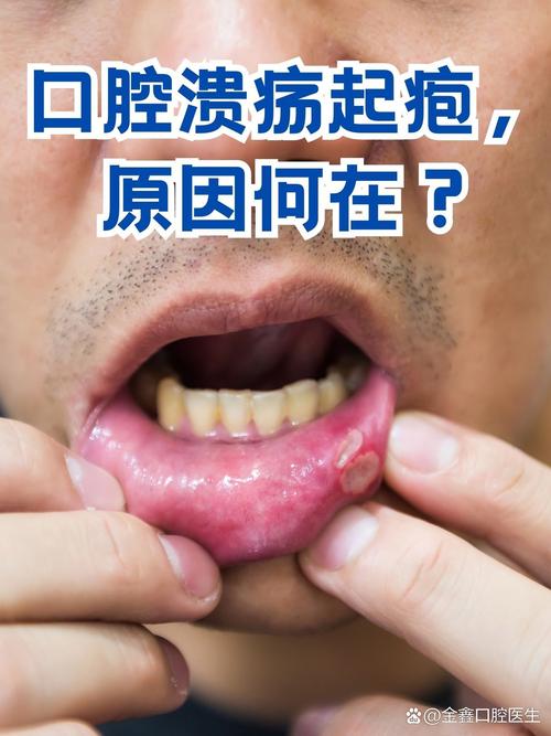 口腔溃疡为何频发?图片揭示诱因?