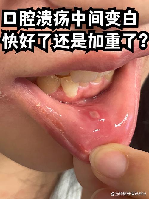 口腔溃疡多久能好?