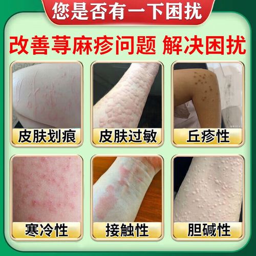 中药过敏后如何正确处理?