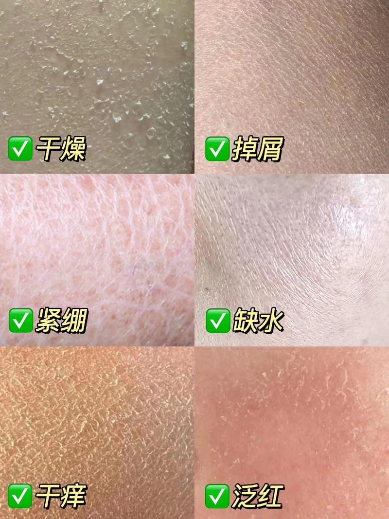 皮肤纤维化是什么意思