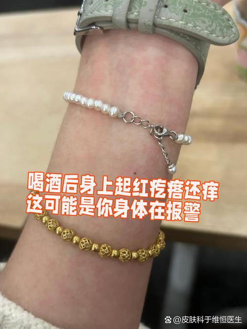 喝酒后皮肤痒是酒精过敏还是其他原因?