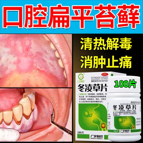 口腔扁平苔藓涂什么药最有效?