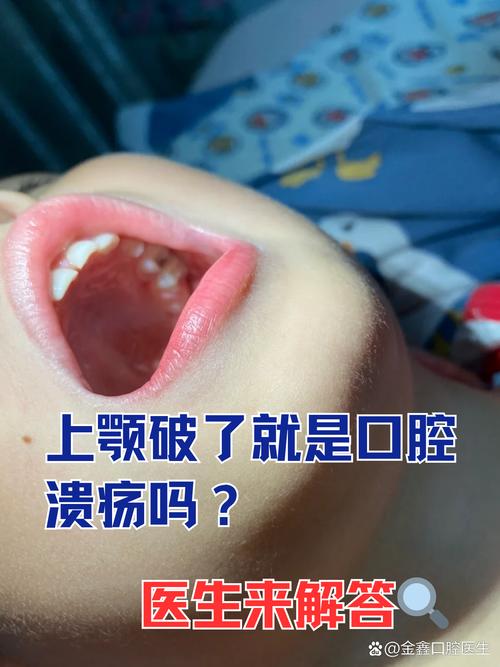 口腔溃疡会引发牙疼吗?