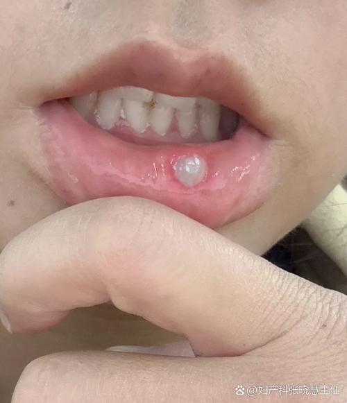 口腔溃疡白色假膜能强行挖掉吗?