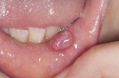 口腔腮部软疙瘩是何问题?