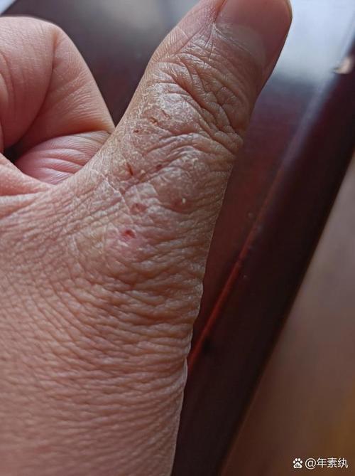 手指关节处皮肤增厚痒