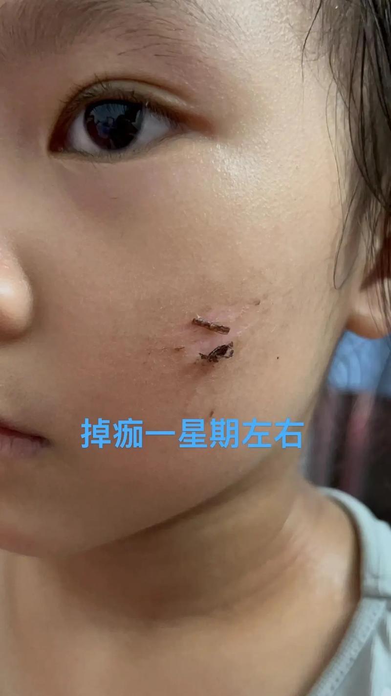 皮肤掉痂后发红,怎么护理才好?