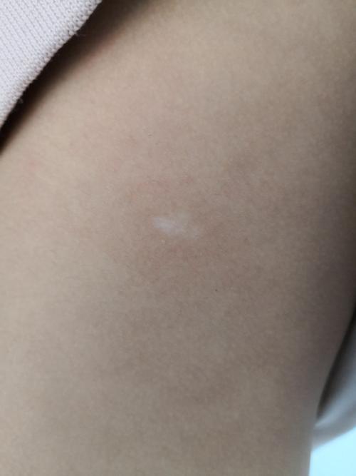 后背有一块白色的皮肤