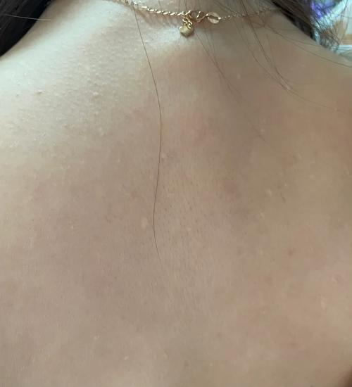 后背有一块白色的皮肤