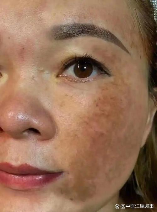 哪种肤质更易长斑?