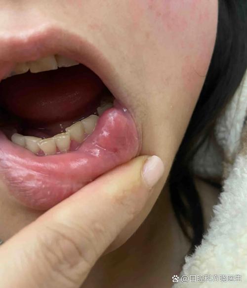 口腔内壁凸起一坨是何问题?