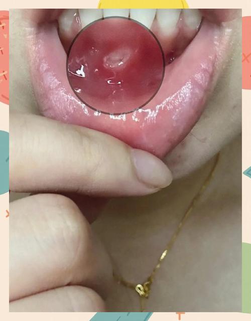 8个多月孕妇口腔溃疡