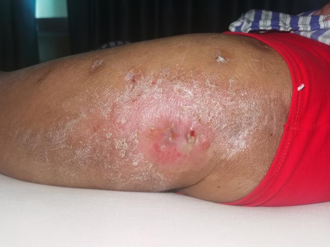 内蒙古附属医院皮肤科擅长哪些疾病诊疗?