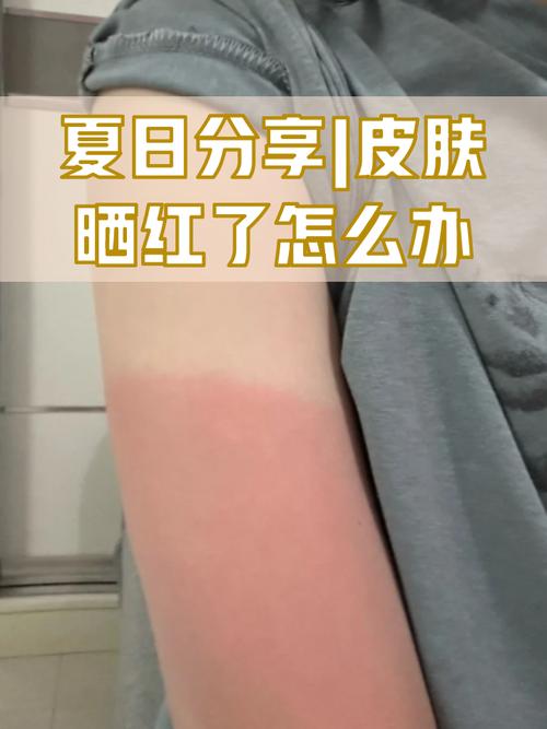 皮肤晒红刺痛,如何快速缓解修复?