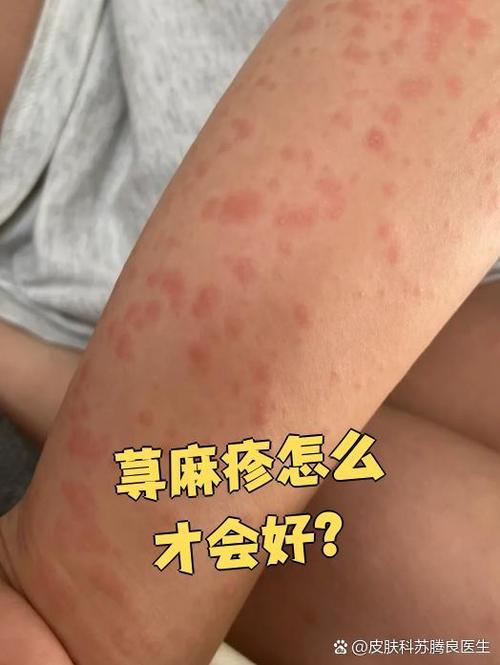 皮肤过敏如何引发荨麻疹?