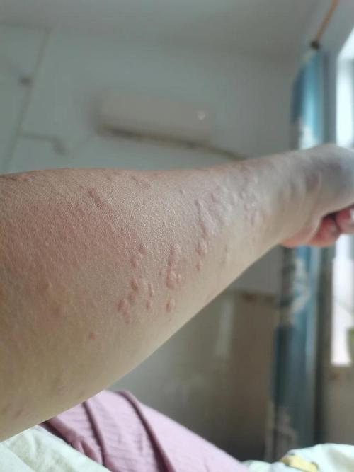 皮肤过敏如何引发荨麻疹?