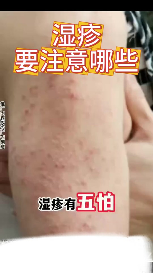 皮肤起痒疙瘩怎么办?