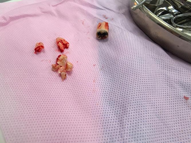 拔智齿该挂口腔哪个科?