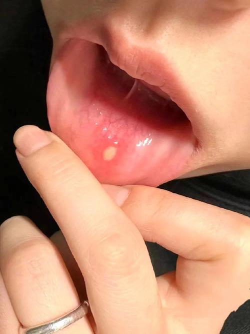 口腔溃疡能用头孢治吗?