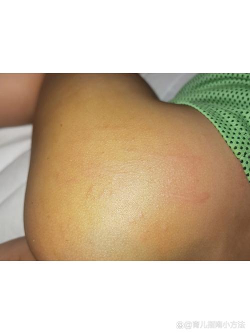 宝宝皮肤痒抓后起疙瘩怎么办?