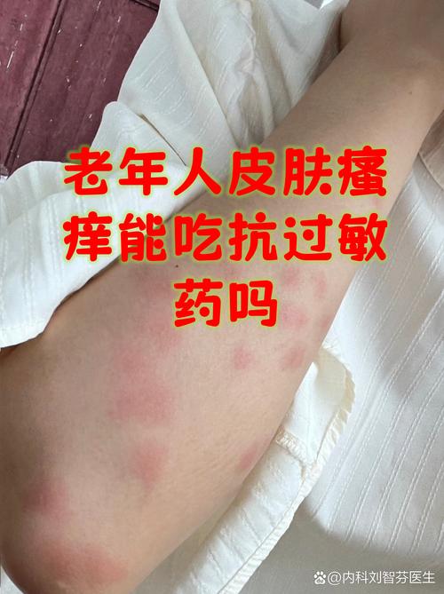 老年人皮肤瘙痒的绝招是什么?