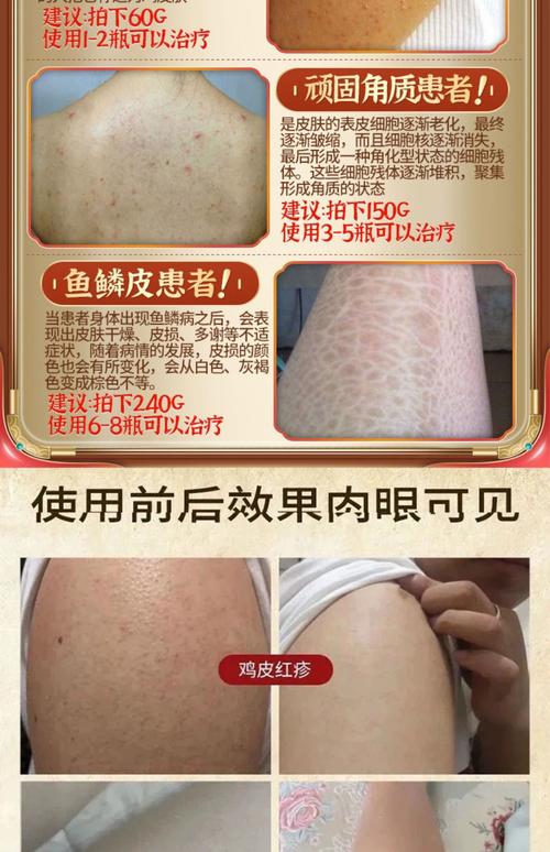 治鸡皮肤药膏叫什么?哪种有效?