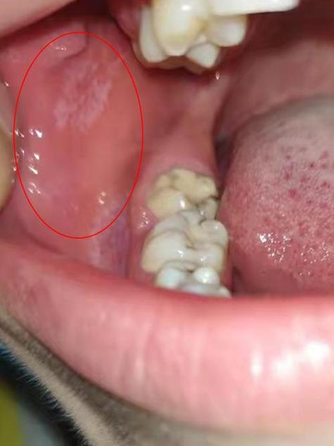 口腔早上脱皮是上火还是疾病信号?