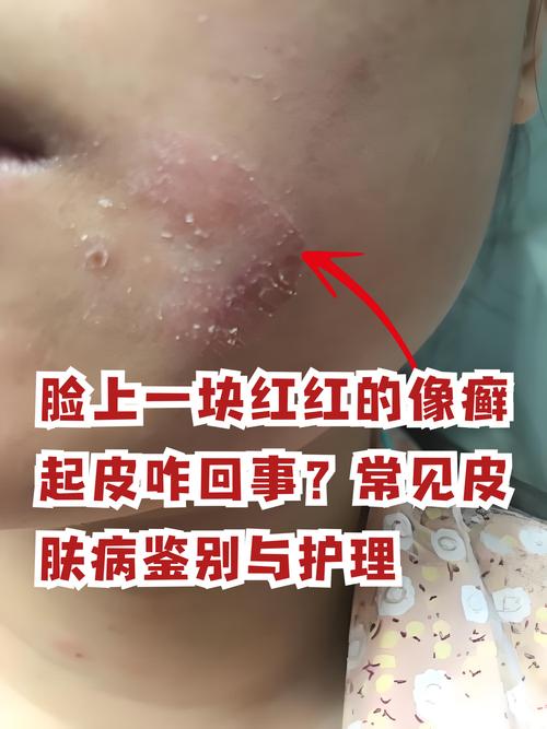 面部皮肤干燥起皮发红