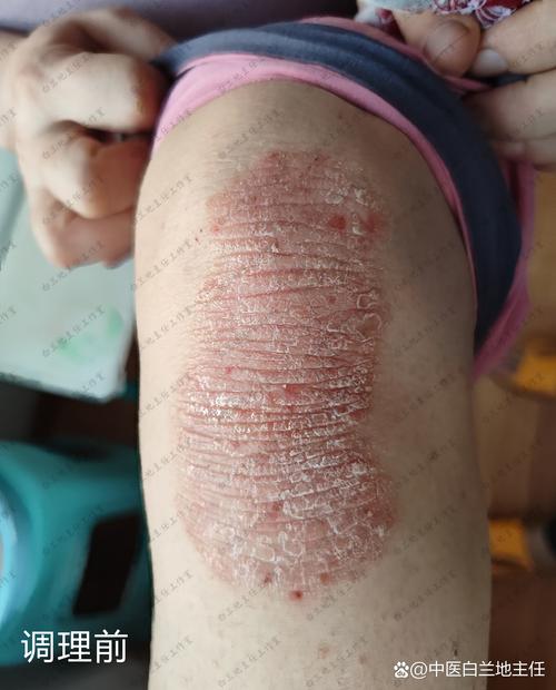 膝盖皮肤粗糙有颗粒感