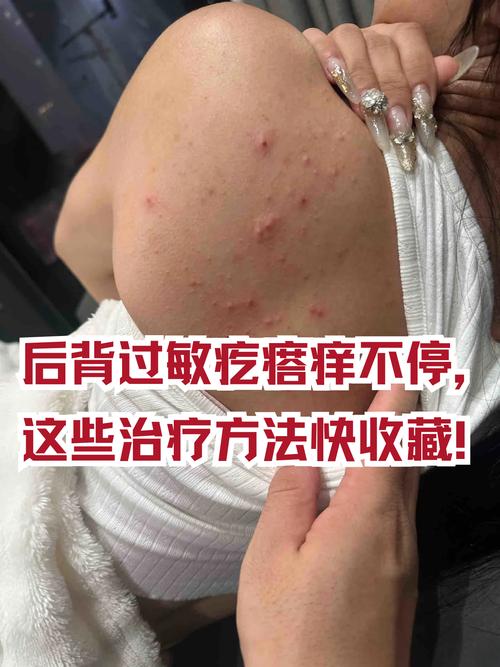 皮肤过敏元凶究竟是什么?